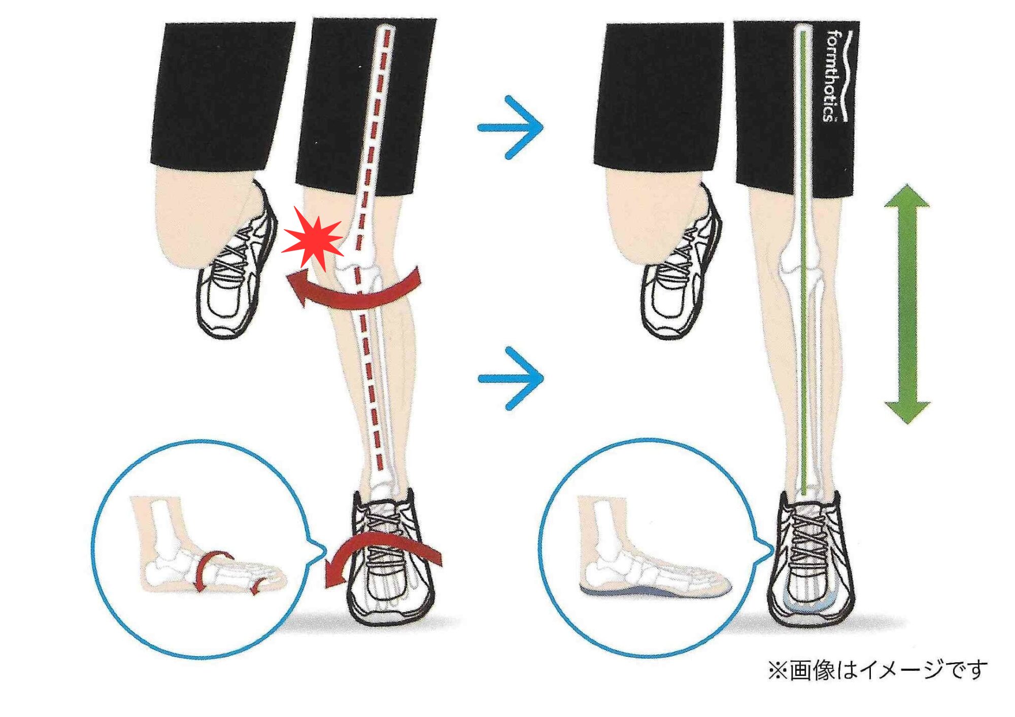 膝のブレや足指の機能低下を示す動作イメージ