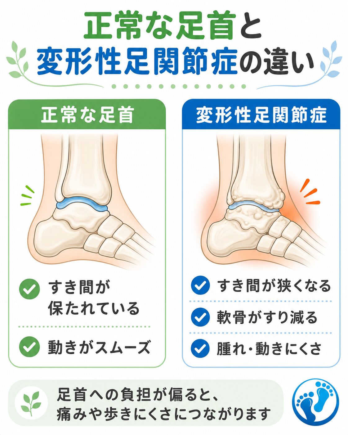 変形性足関節症で足首の関節のすき間が狭くなる様子を示した図解