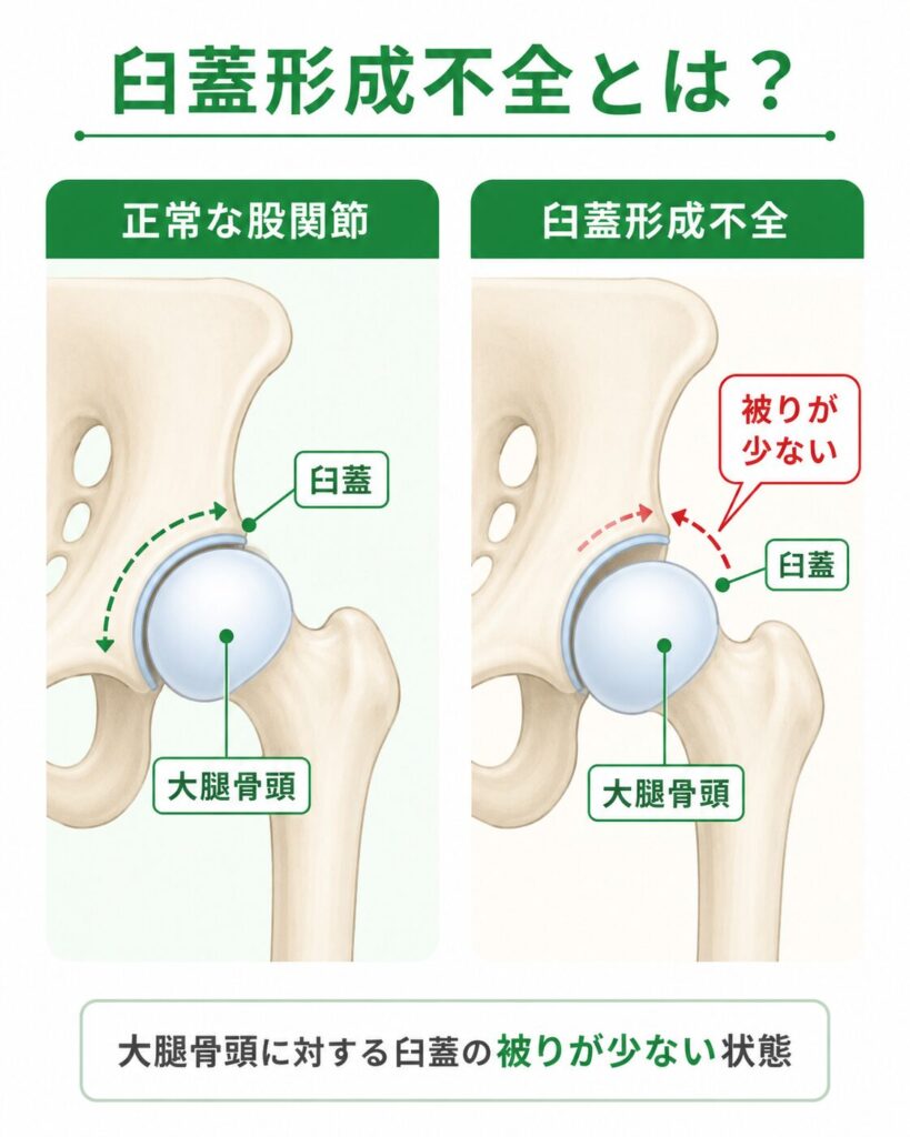 大腿骨頭に対する臼蓋の被りの違いを、正常な股関節と臼蓋形成不全で比較した図