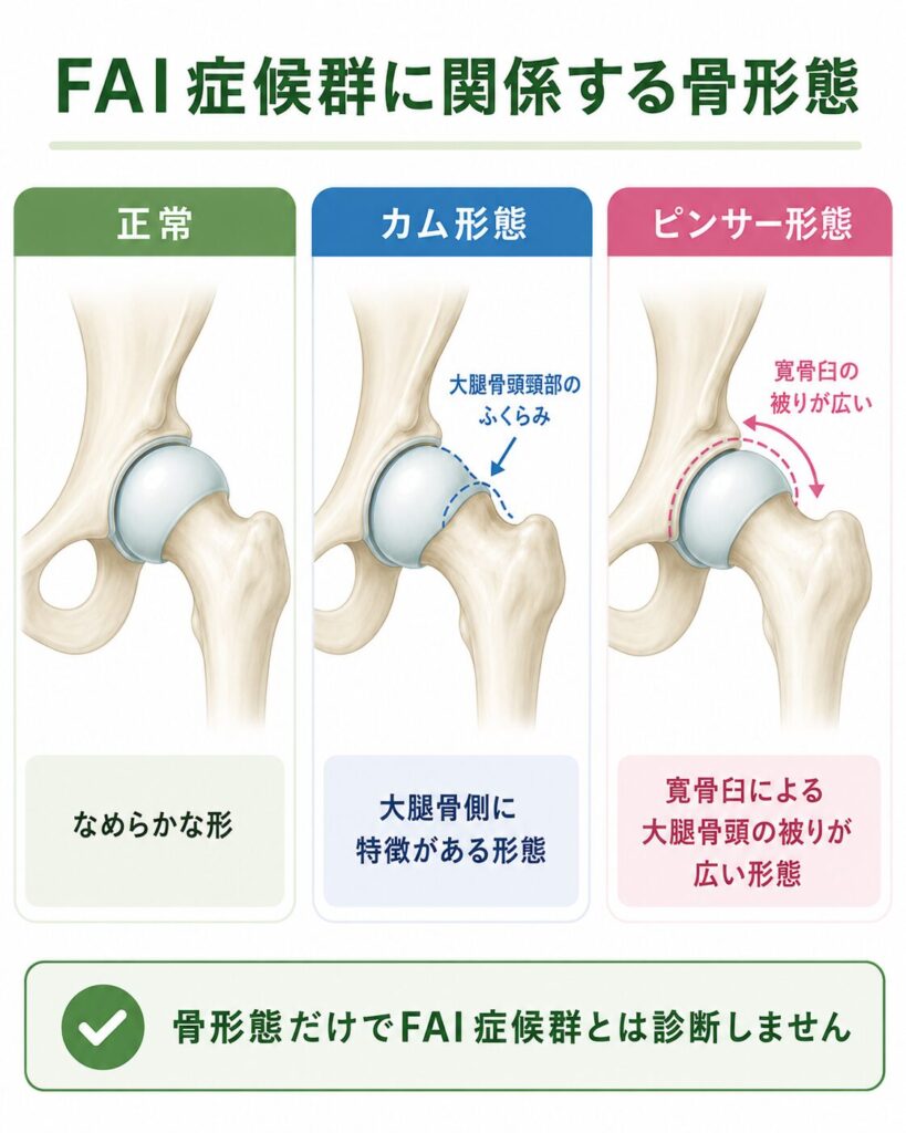 正常な股関節とカム形態・ピンサー形態の違いを比較し、骨形態だけではFAI症候群と診断しないことを示した図