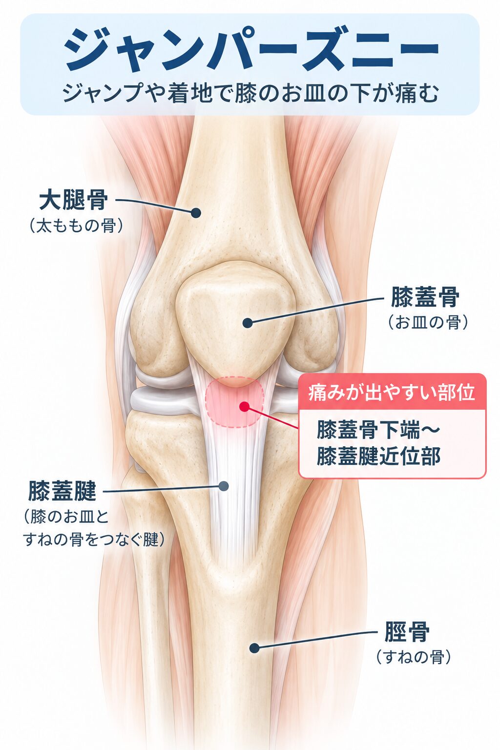ジャンパーズニーで痛みが出やすい膝蓋骨と膝蓋腱の位置